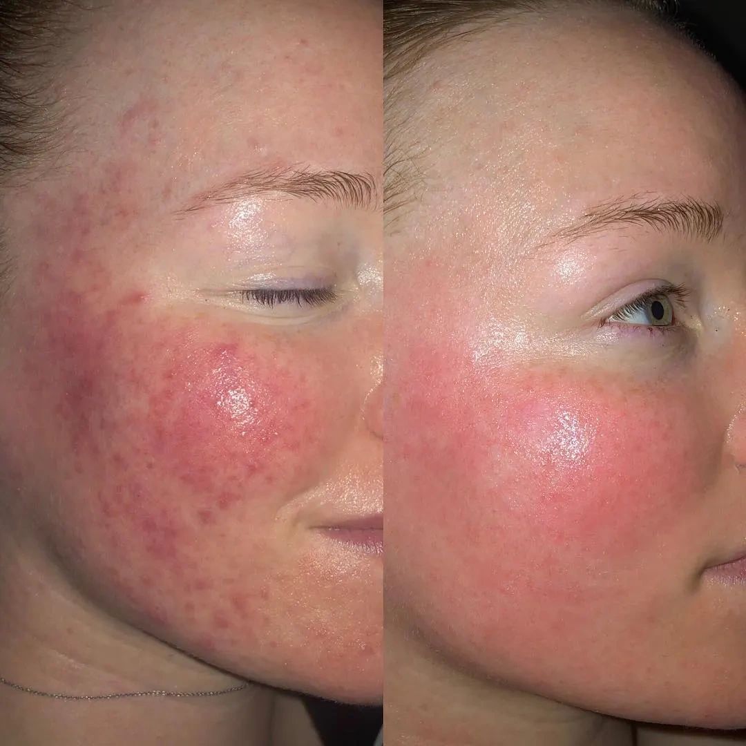 Treatment result