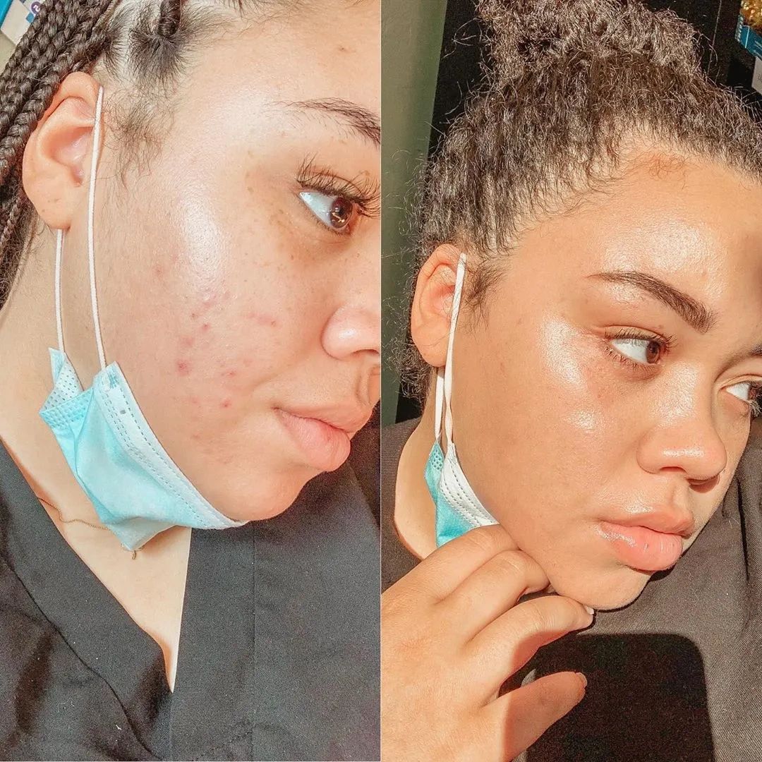 Treatment result