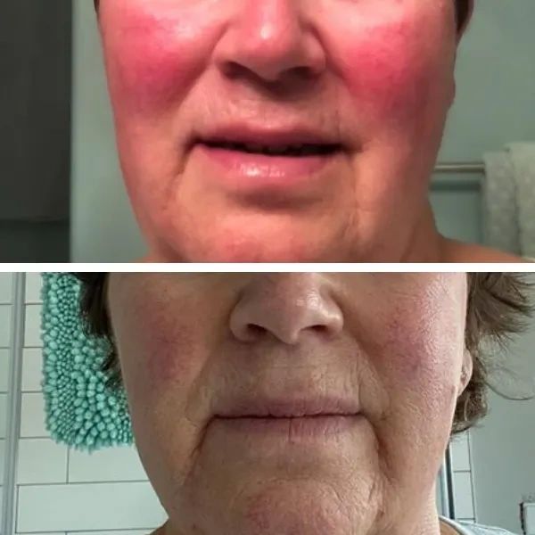 Treatment result